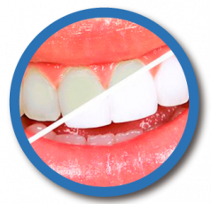 gallery/blanqueamiento